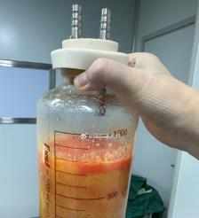 鄂州水动力吸脂手术要做多久？